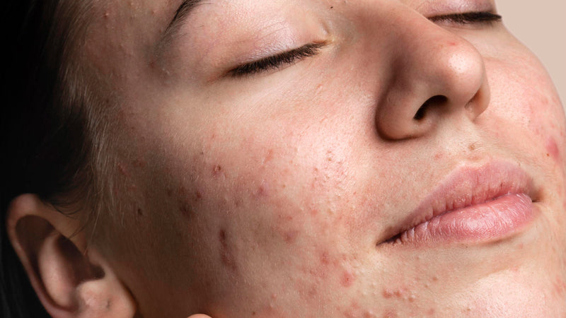 Wat is fungal acne